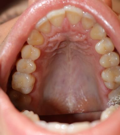 clear aligner teeth straightening before and after Vere Dental Battersea SW11