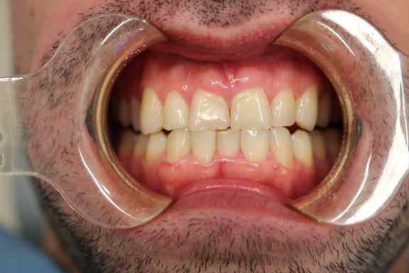 professional teeth whitening before and after results Vere Dental Battersea SW11