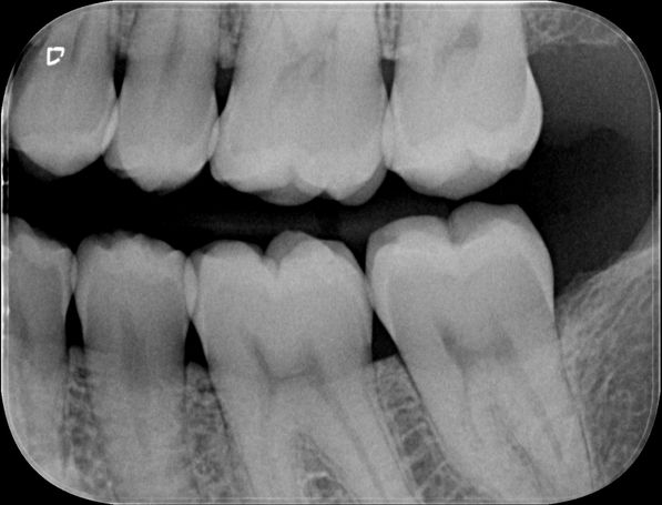 Dental X-Ray