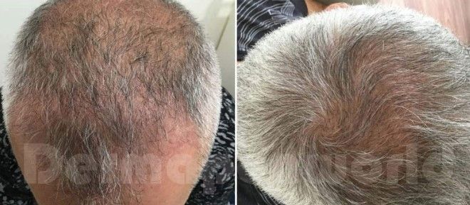 Microneedling Hair Loss Before
