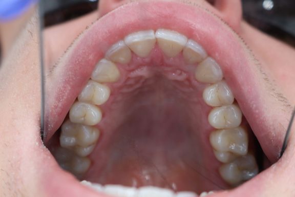 clear aligner teeth straightening before and after Vere Dental Battersea SW11