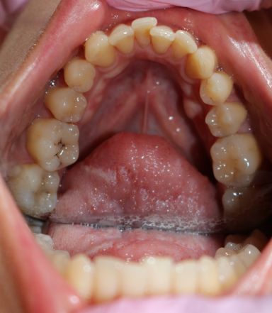 clear aligner teeth straightening before and after Vere Dental Battersea SW11