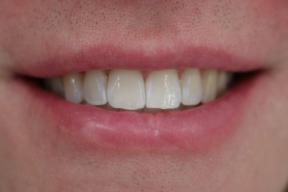 clear aligner teeth straightening before and after Vere Dental Battersea SW11