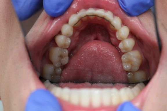 clear aligner teeth straightening before and after Vere Dental Battersea SW11