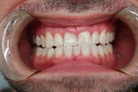 professional teeth whitening before and after results Vere Dental Battersea SW11