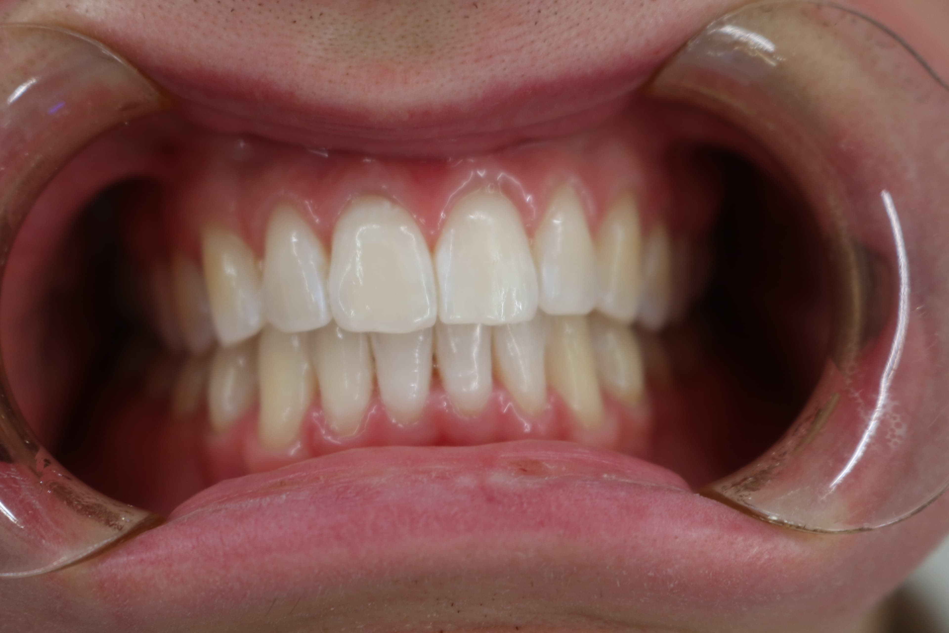 Smile after clear aligner treatment