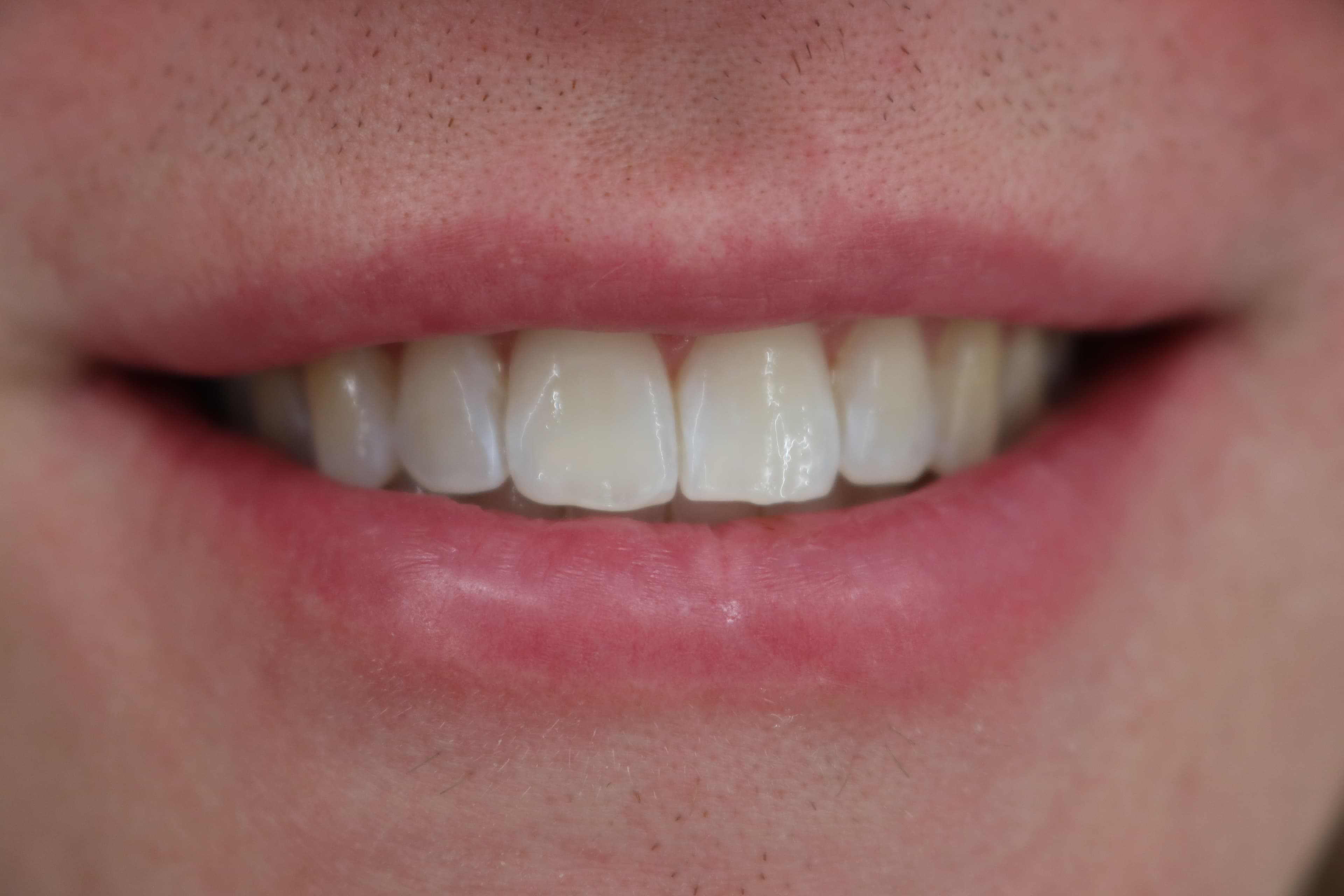 Smile before clear aligner treatment