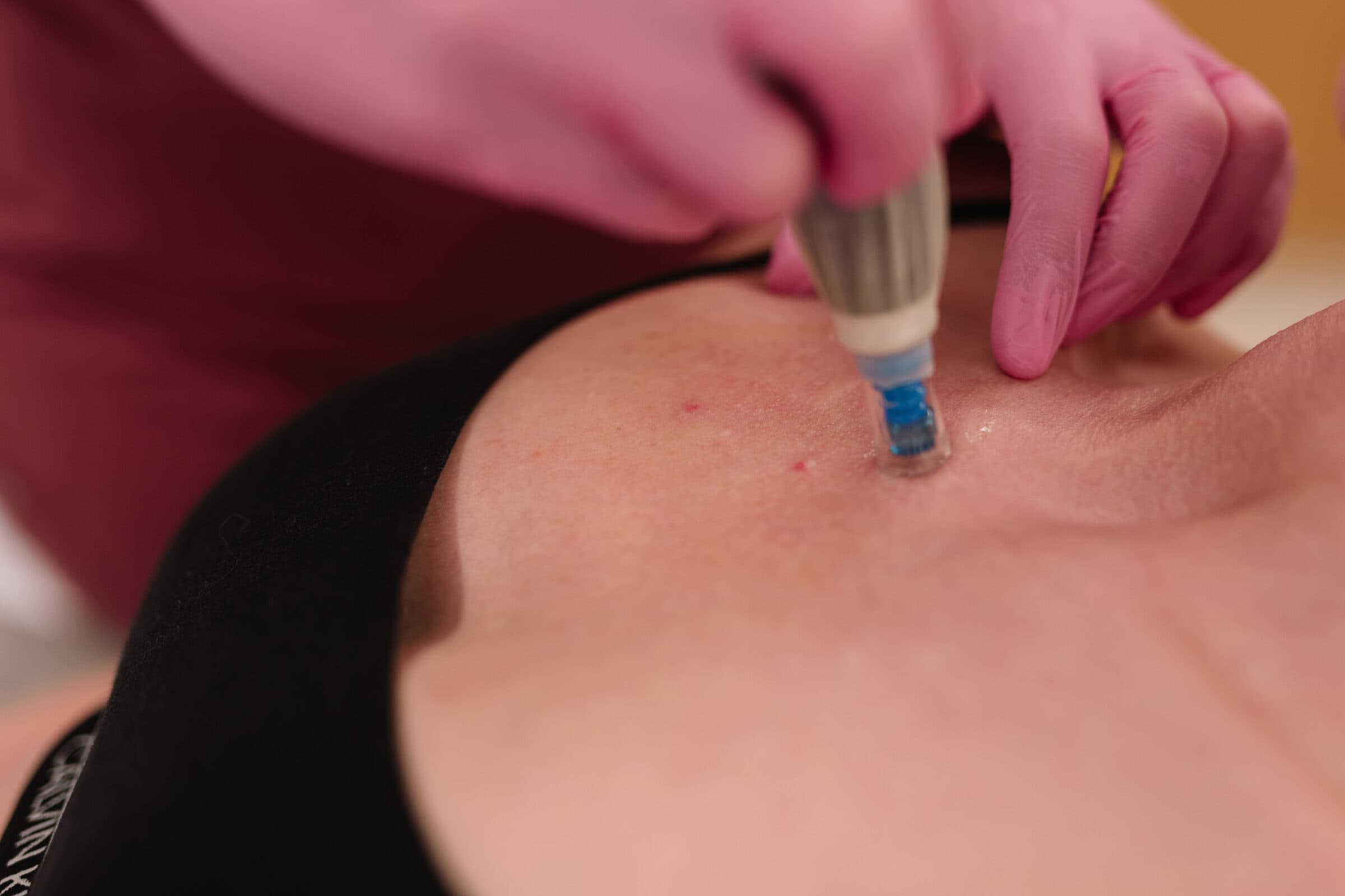 Microneedling at Vere Dental