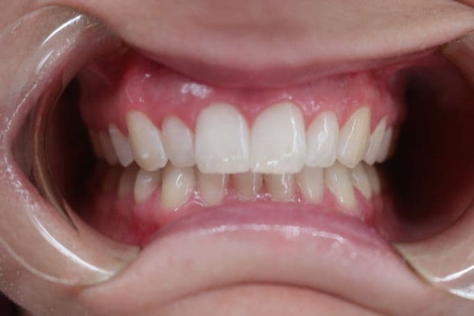 Skin after microneedling treatment