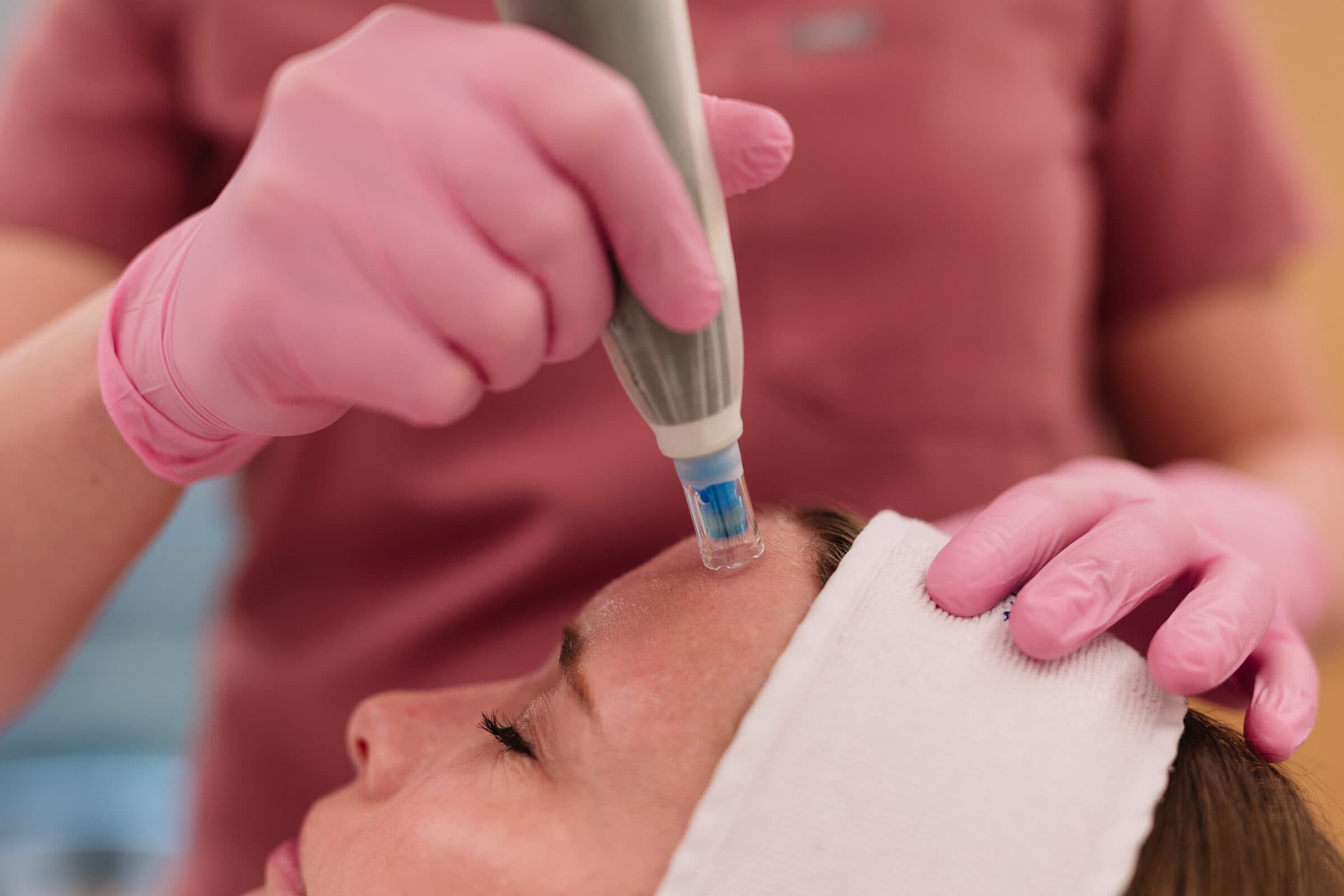 Microneedling
