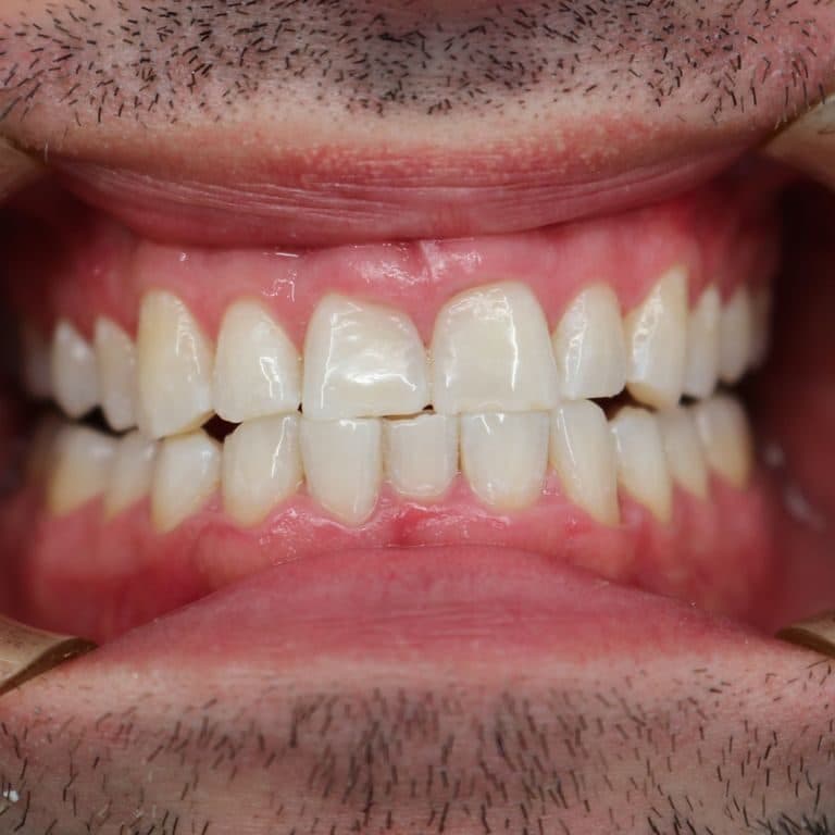 After teeth whitening