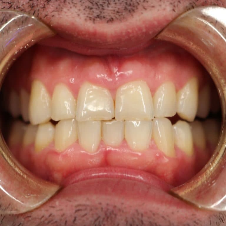 Before teeth whitening